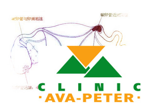 一边输卵管堵塞能做人授吗?