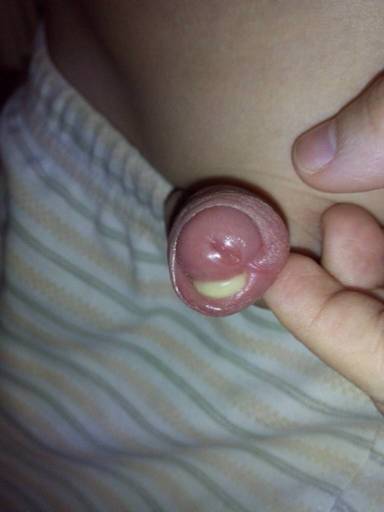 男性包皮,到底切还是不切? 男性包皮,到底切还是不切?