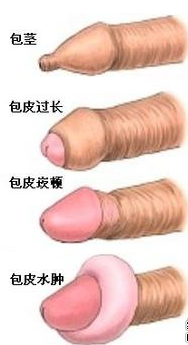 男性包皮,到底切还是不切? 男性包皮,到底切还是不切?