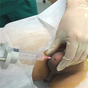 睾丸穿刺活检和显微镜下睾丸切开取精术 睾丸穿刺活检和显微镜下睾丸切开取精术