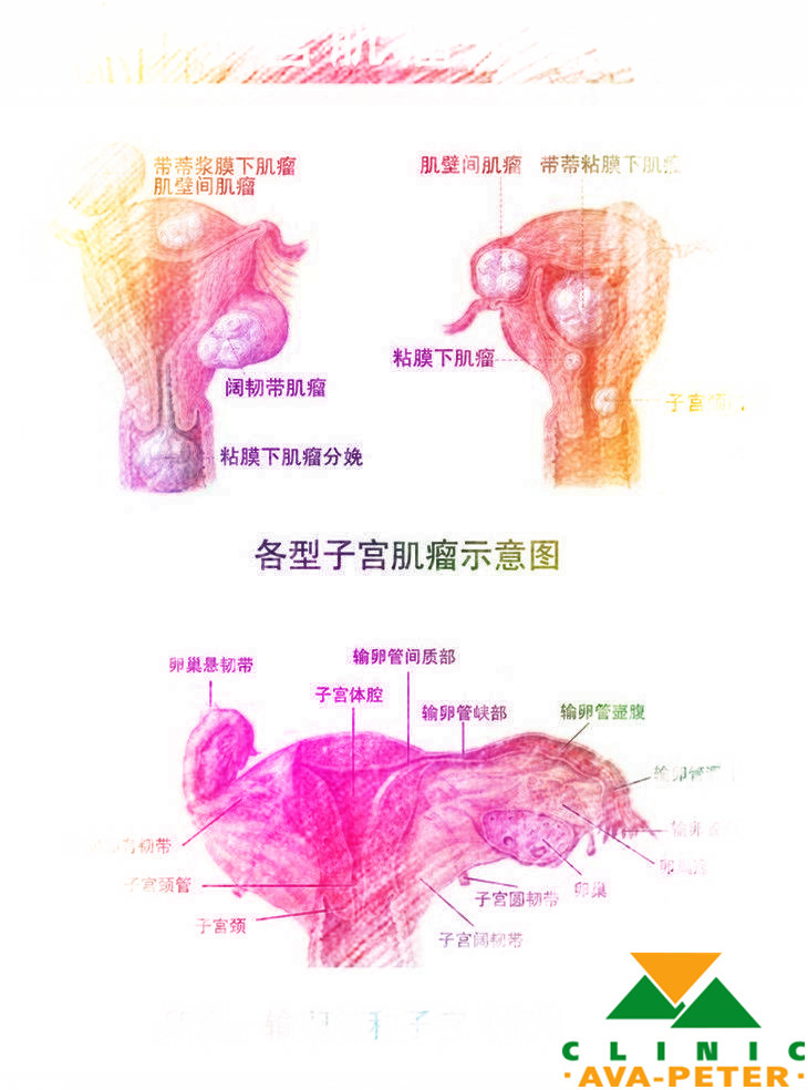 刘畊宏曝妻子曾患子宫肌瘤,屡次尝试才艰难生下小泡芙! 子宫肌瘤